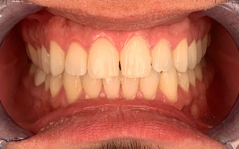 cosmetic dentistry veneers