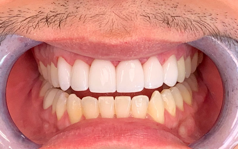 cosmetic porcelain veneers