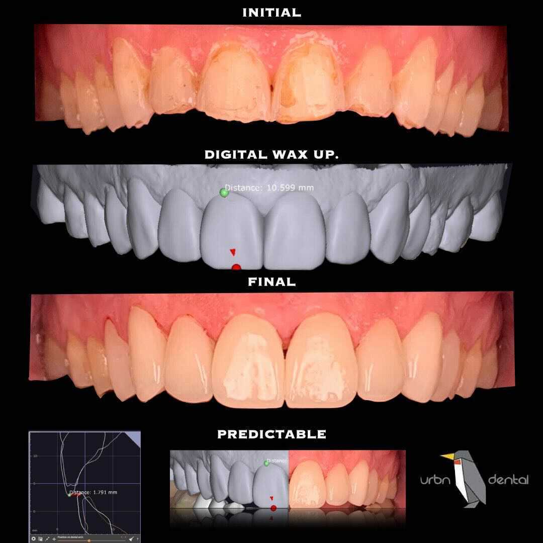 Porcelain Veneers Before And After Dental Veneer Houston