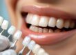 Veneers Near Me